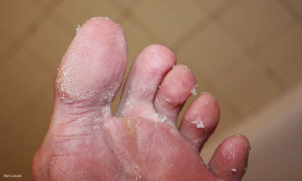 résultat pelade baby foot