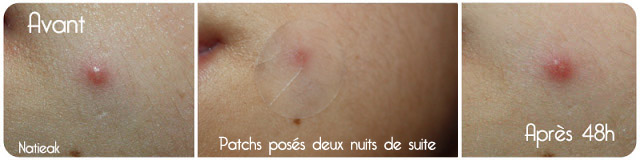 Patchs peaux tendance acnéique de Joliderm