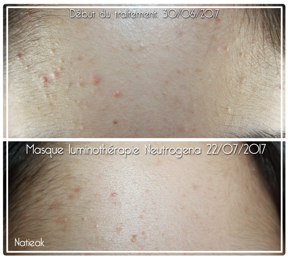 masque luminothérapie avis dermatologue